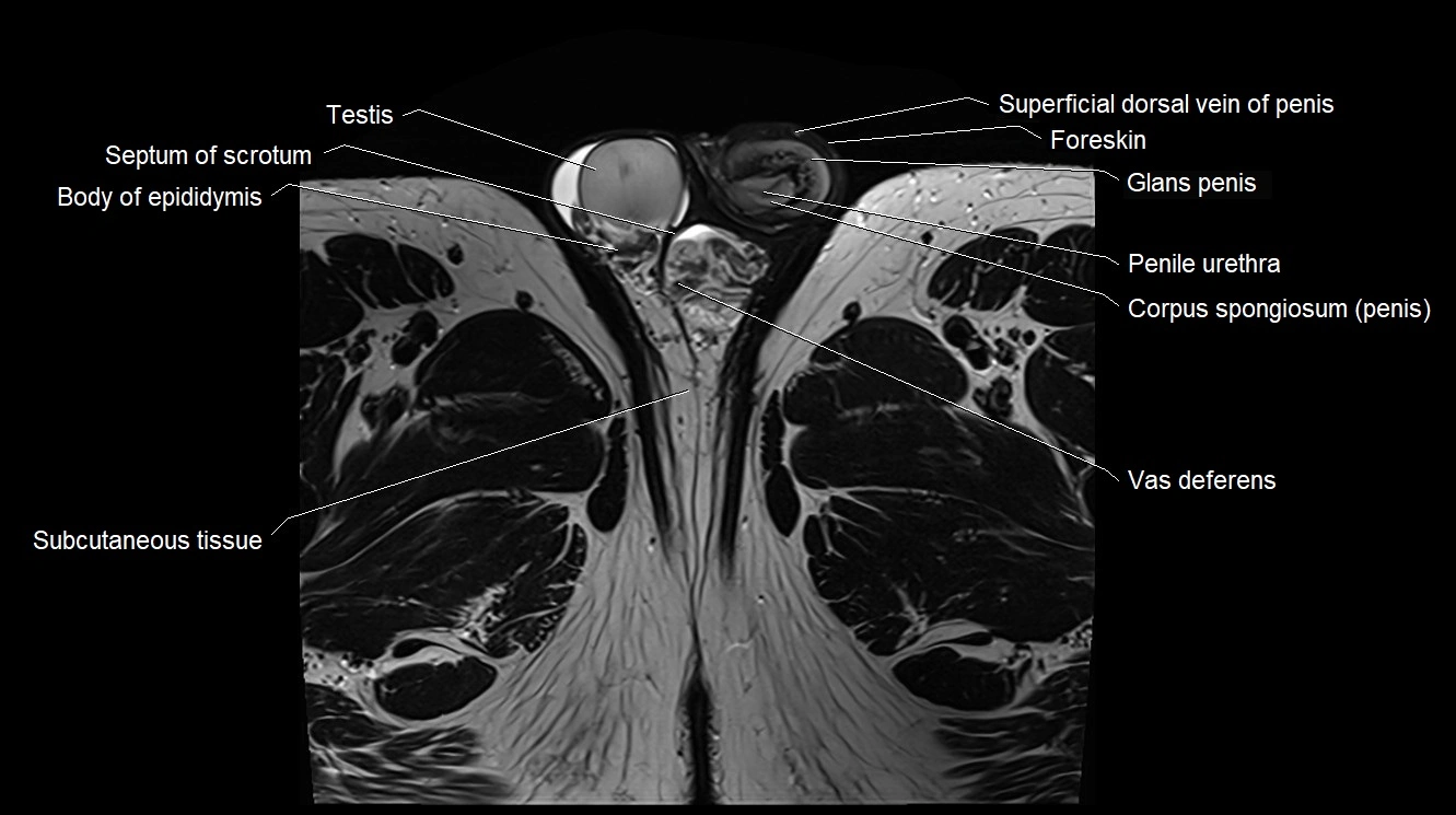 MRI 3T scrotum and penis axial cross sectional anatomy image 30.webp